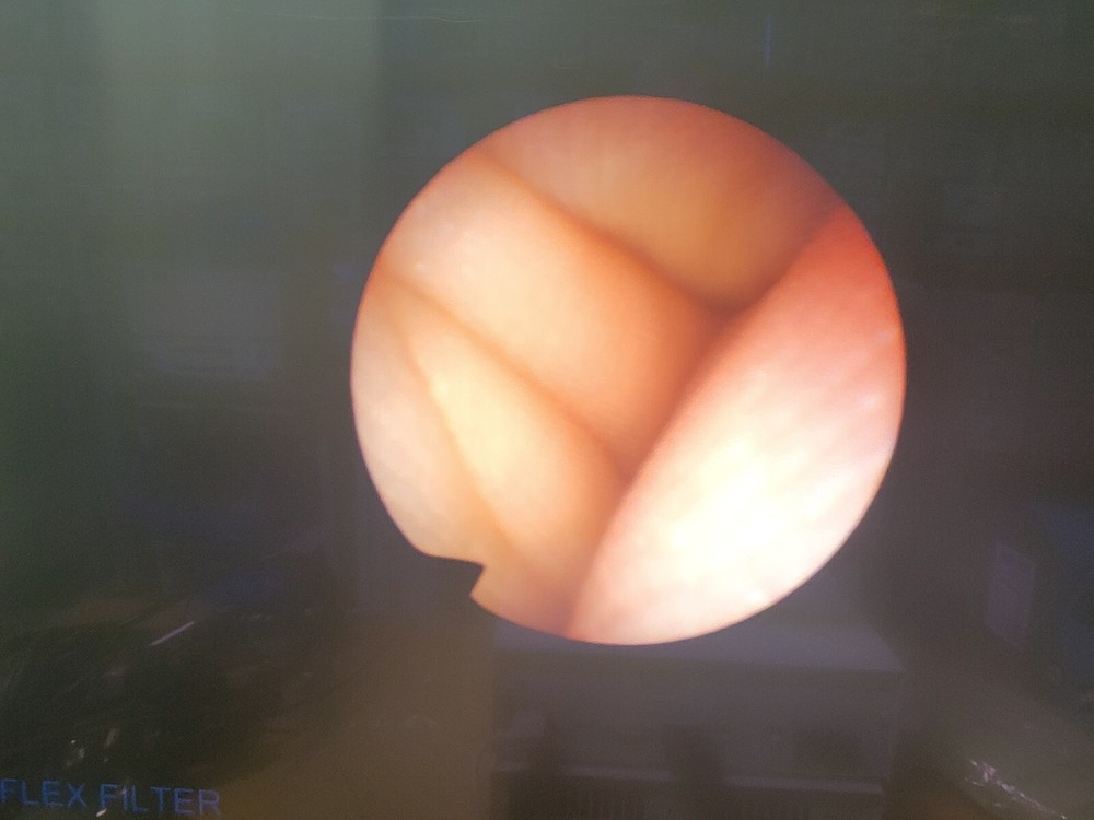 Olympus Arthroscope A7506A w Sheath & Light Cable