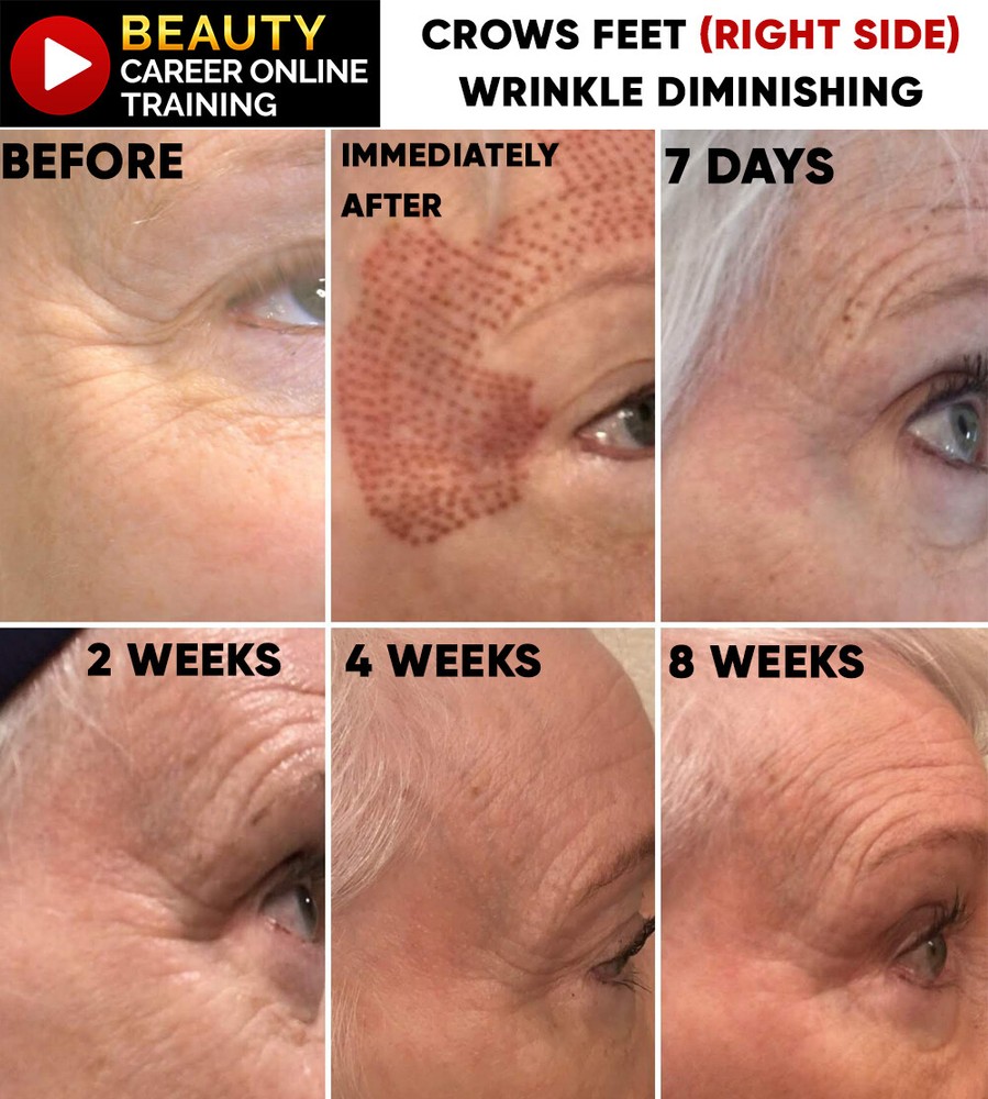 Beauty Career Wrinkle Reducing Complete Online Training Certification Course
