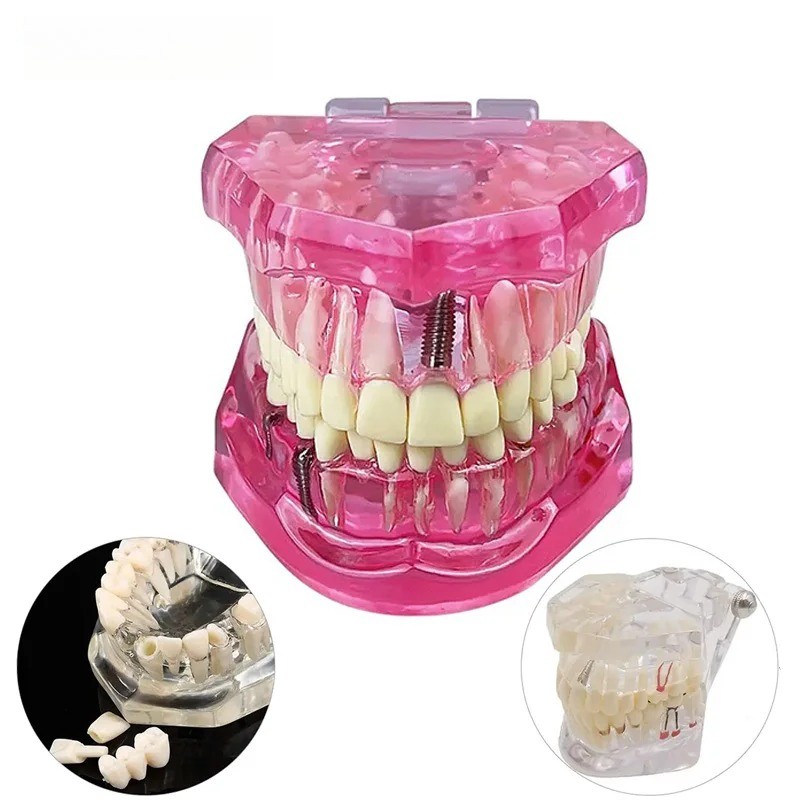 Teeth Repair Model Disease Teeth for Dentist Student Practice Training Studying