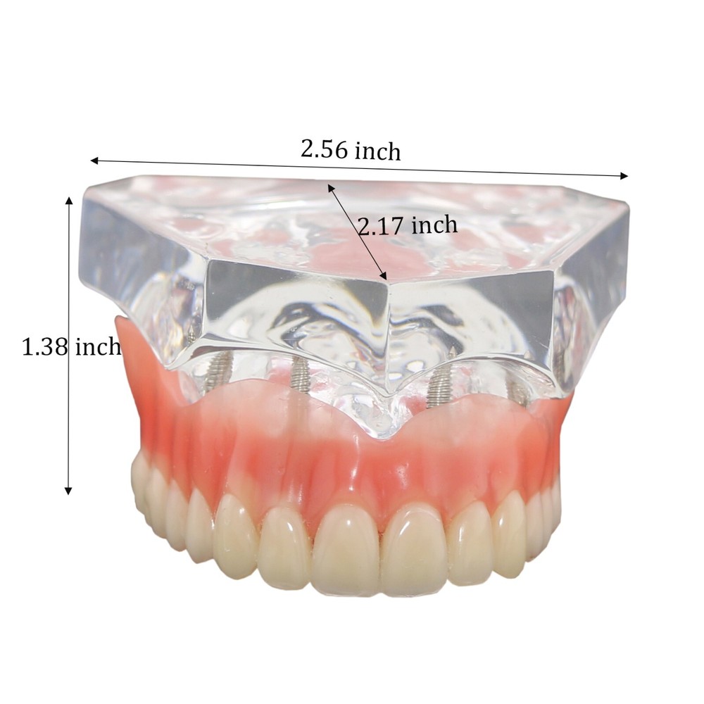 Dental Typodont Implant Overdenture Teeth Model 4 Implants Upper Lower