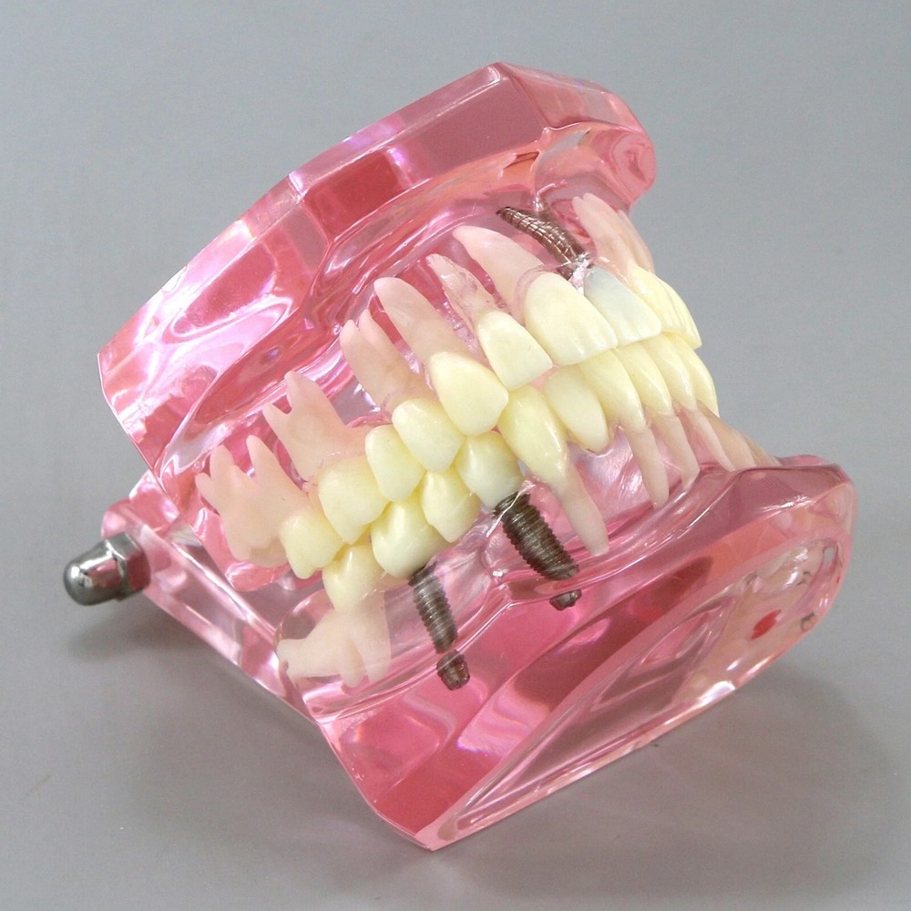Dental Teeth Model Multiple Types Ortho Implant Practice Teaching Demo Model