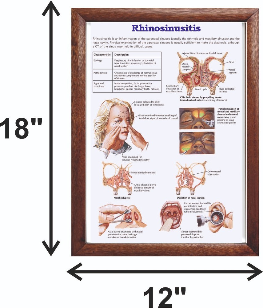 Rhinosinusitis Chart 12x18 inches