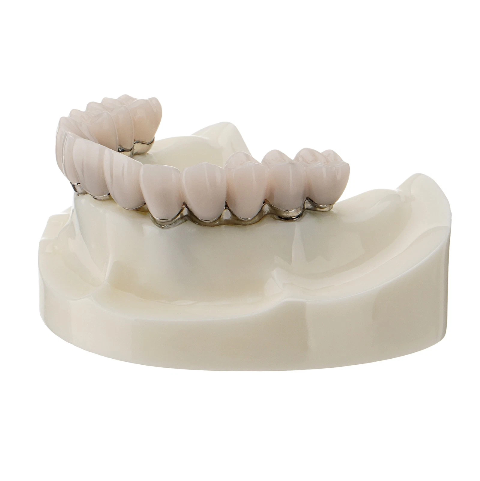 Dental All-on-4 Overdenture Model Dental Upper Jaw Implants Restoration 4 Screws