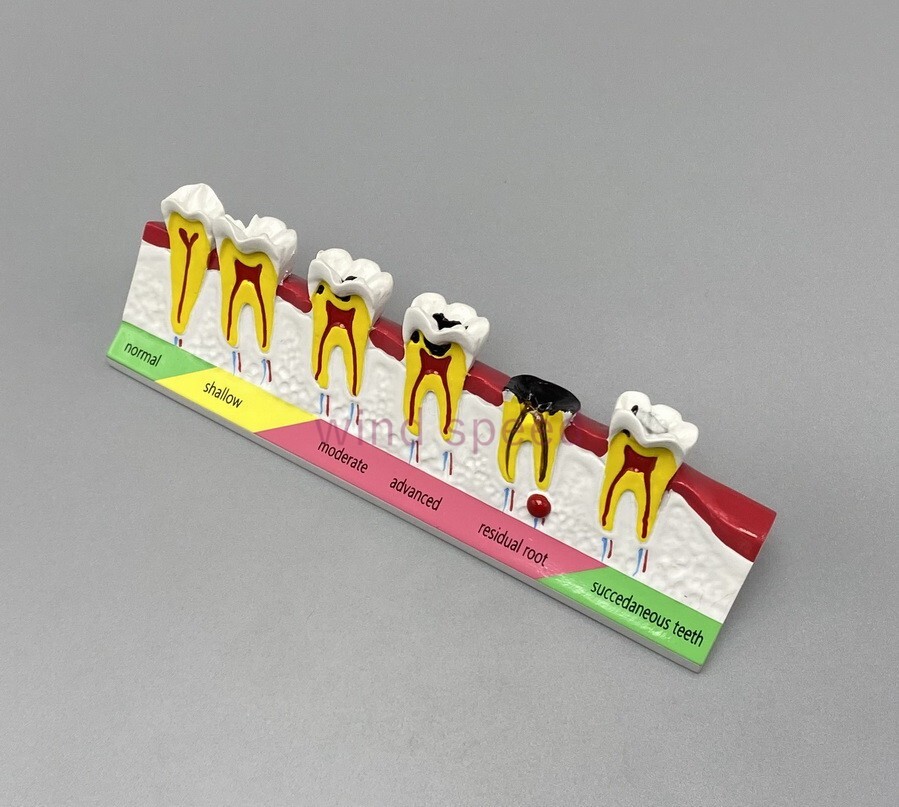 New Dental Study Teaching Models Caries Disease Assort Teeth Dentoform Model