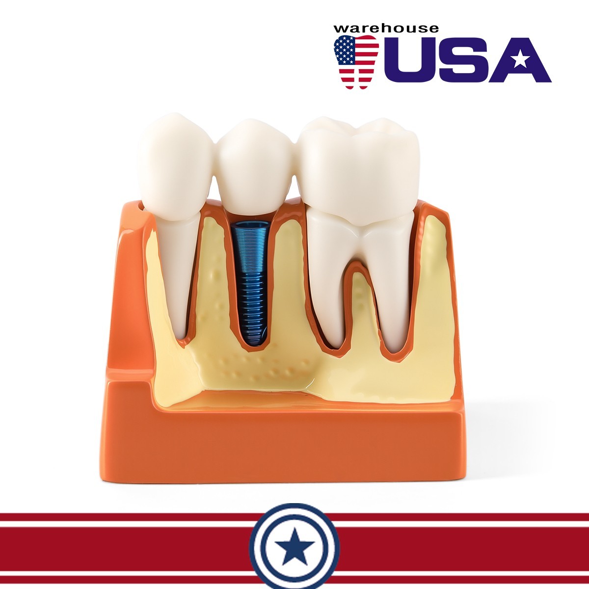 Dental 4 Times Teeth Model Implant Analysis Crown Bridge Demonstration Removable