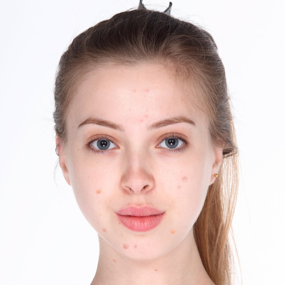 Le Pore Serum (Acne Serum, Pore Serum)