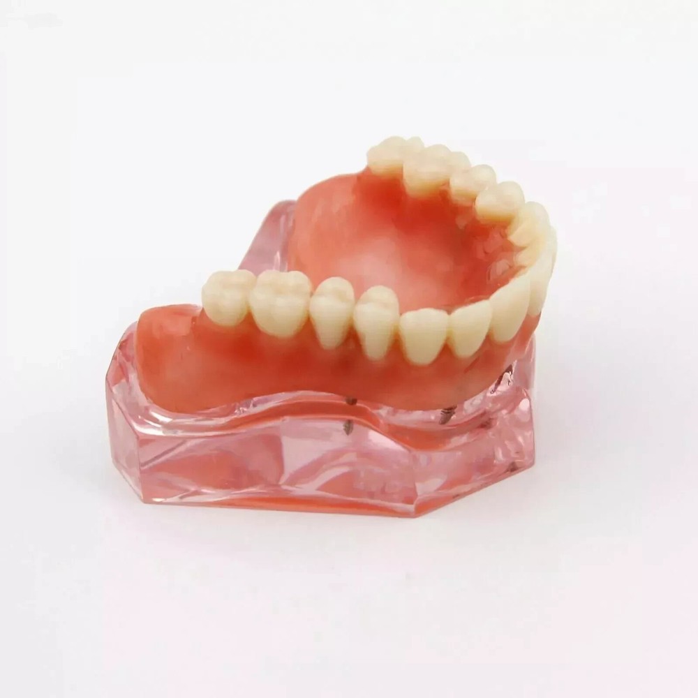 Dental Restoration Teeth Typodont Implants Model Demonstrate Overdenture 3 Model