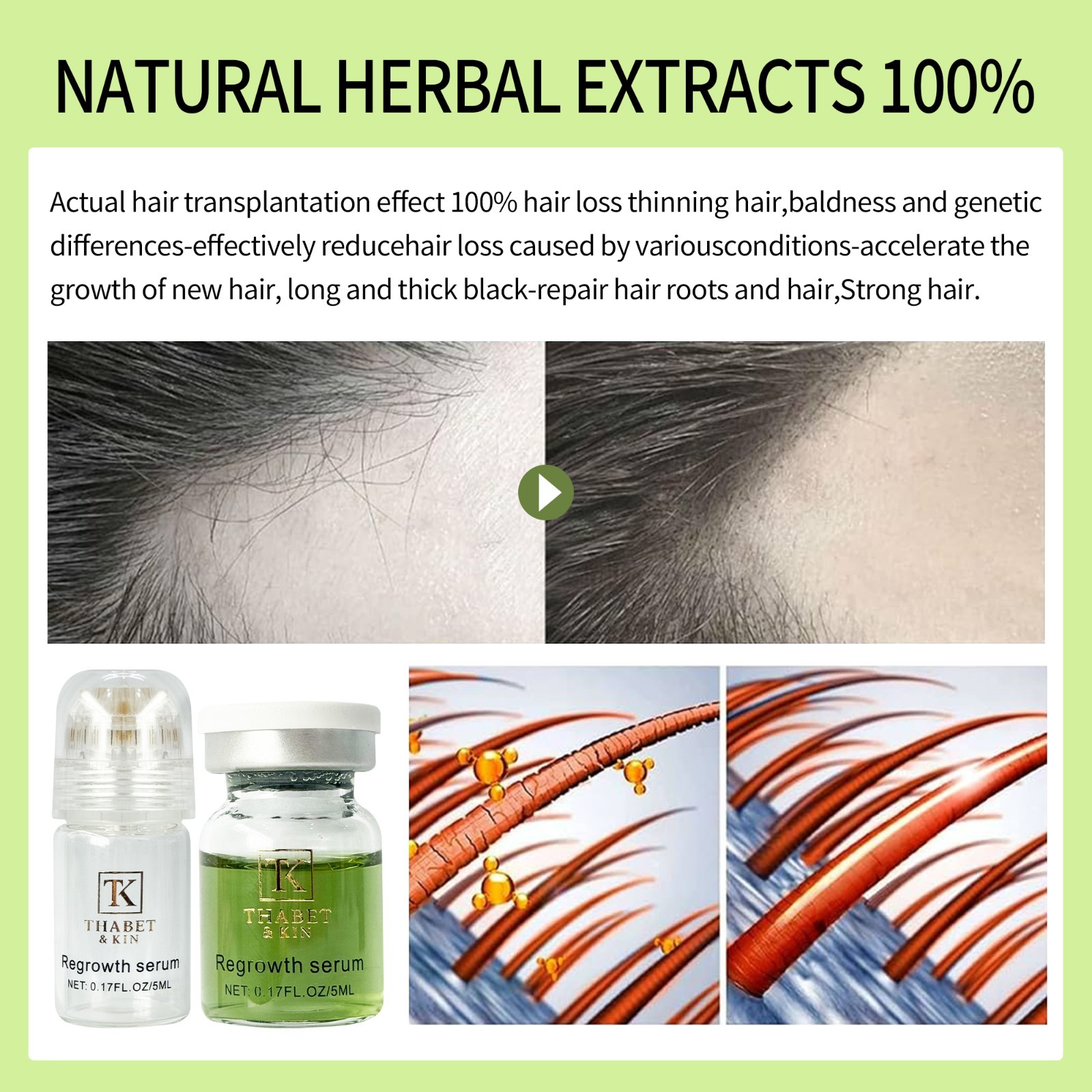 Infuse Hair Regrowth System, Advanced Hair Growth Treatment USA Brand FAST Ship