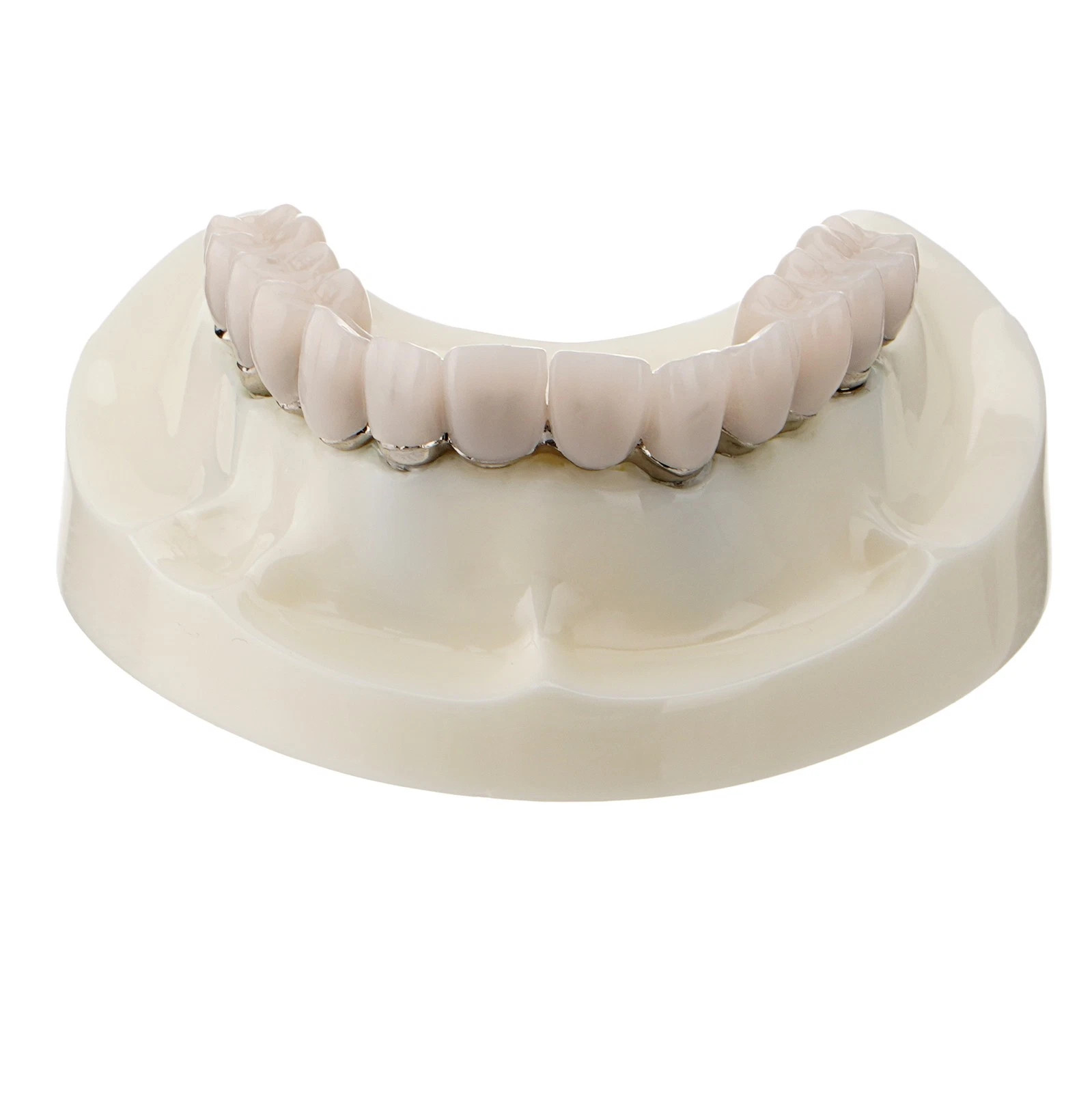 Dental All-on-4 Overdenture Model Dental Upper Jaw Implants Restoration 4 Screws