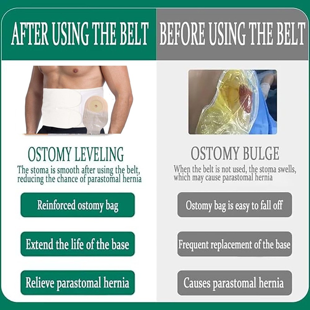 Ostomy Support Belt，Adjustable Prevent Parastomal Hernia Support Belt For