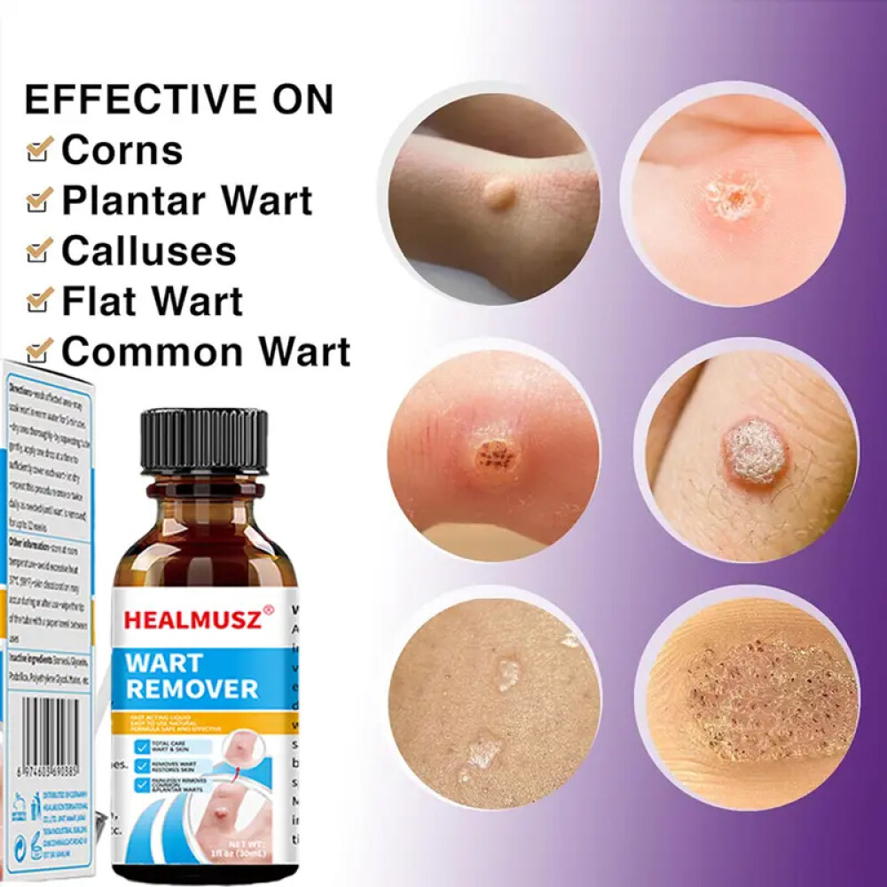 Wart Remover Liquid Skin Tag Mole Remover Eliminate Feet Corn Wart Remove Liquid
