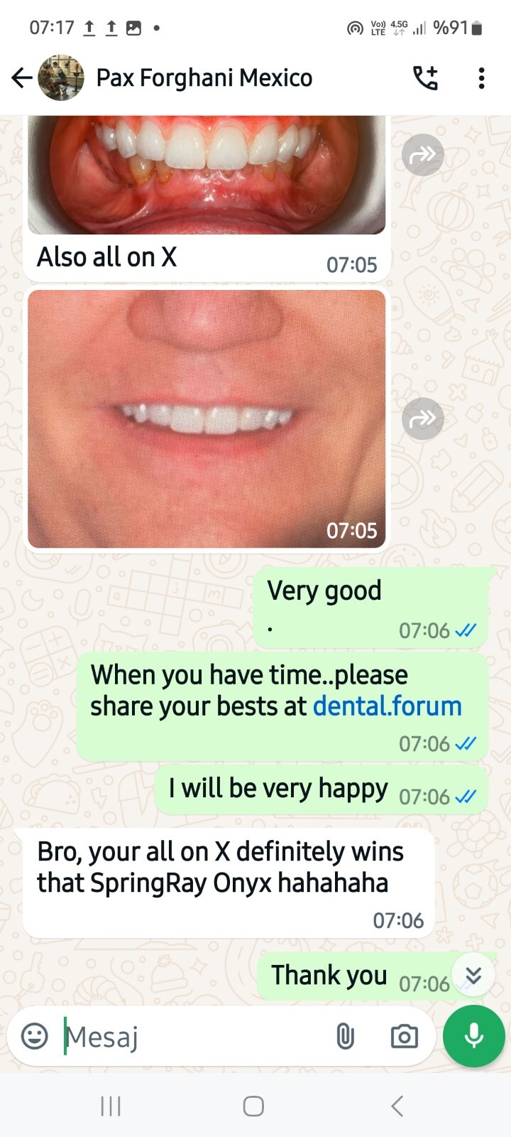 DLP SLA LCD 3d printer ALL ON X resin - for all on x cases, bridges,arcs, hybrid