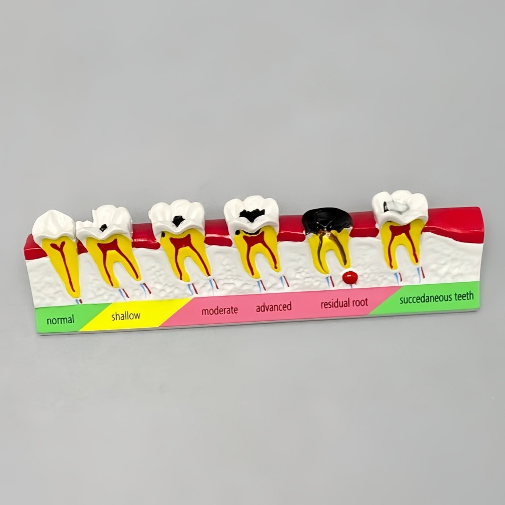 Dental Caries Disease Models Dentoform Typodont Study Teaching Teeth Model Demo