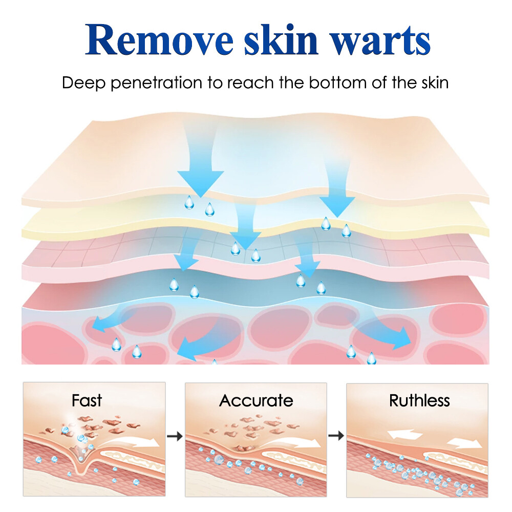 Wart Remover Liquid Skin Tag Mole Remover Eliminate Feet Corn Wart Remove Liquid