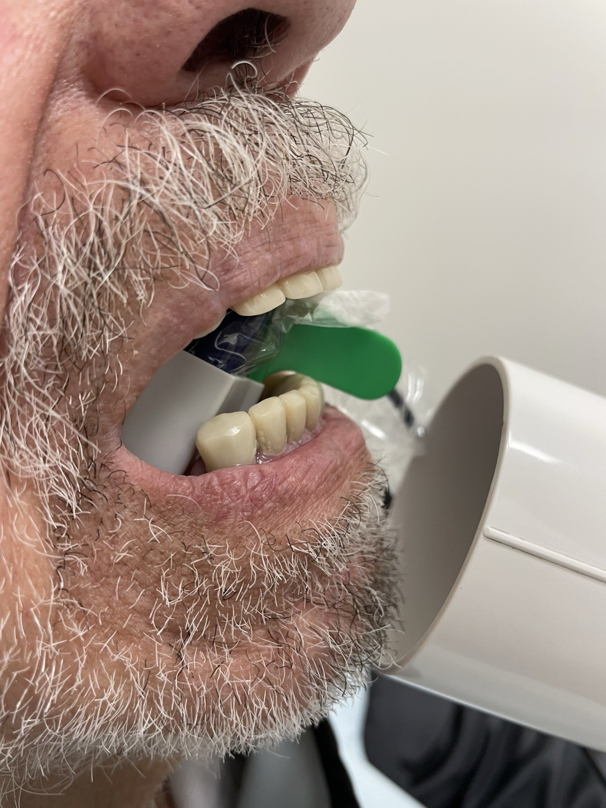 5 pcs Autoclavable - Apical/Bitewing Adult Digital Sensor Positioner-Holder