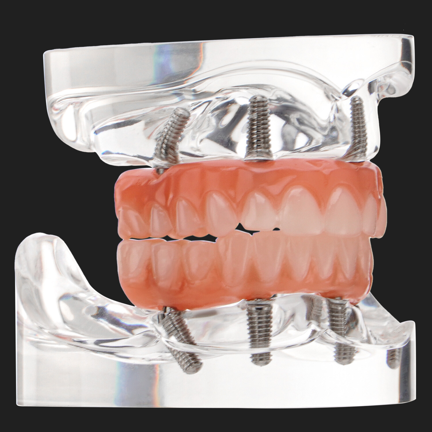 Dental Implant All-on-4 Overdenture Treatment Model Upper/Lower 4 Implants Clear