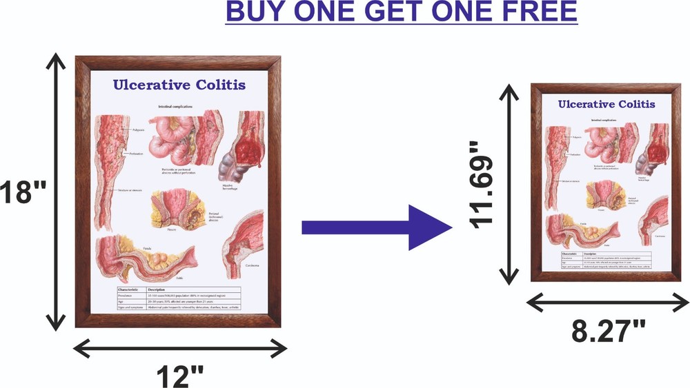 Ulcerative Colitis Chart 12x18 inches