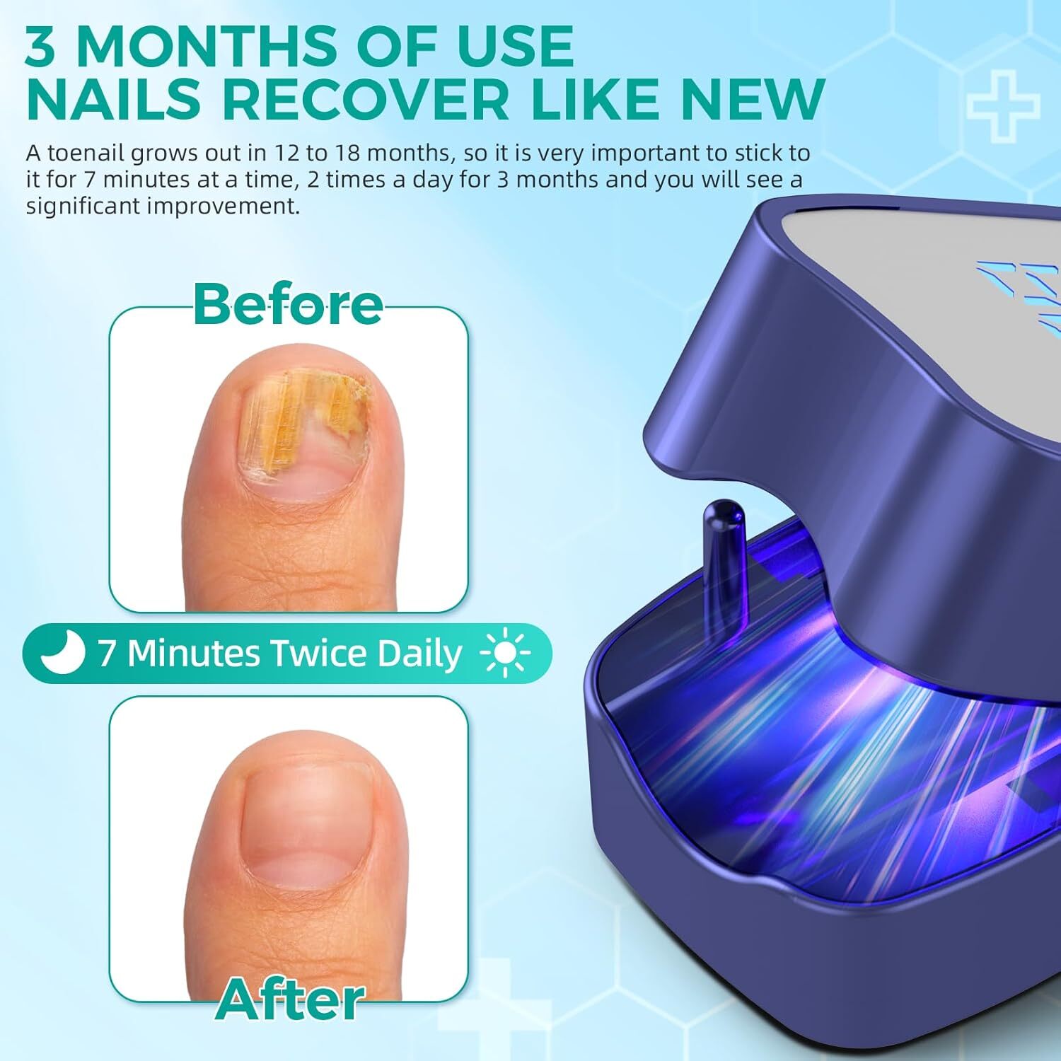 Onychomycosis Toes Treatment Nail Fungus Laser-Device Nail Repair Anti Infection