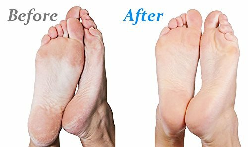 Emjoi Micro Pedi Callus Remover Foot File with Extra Coarse Roller (White)