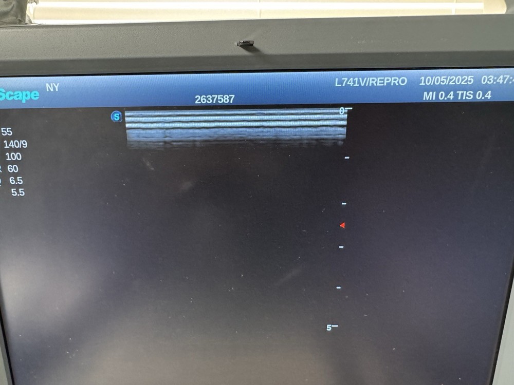 SonoScape Transducer L741V Linear Array/Rectal Probe