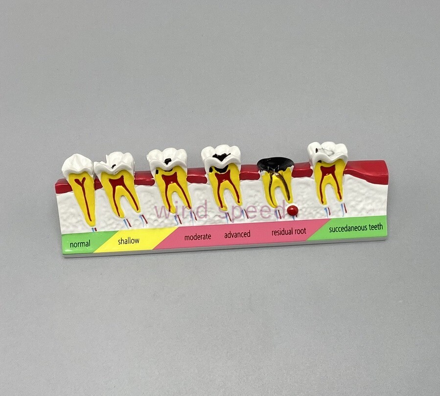 Dental lab Study Teaching Models Caries Disease Assort Teeth Dentoform Model