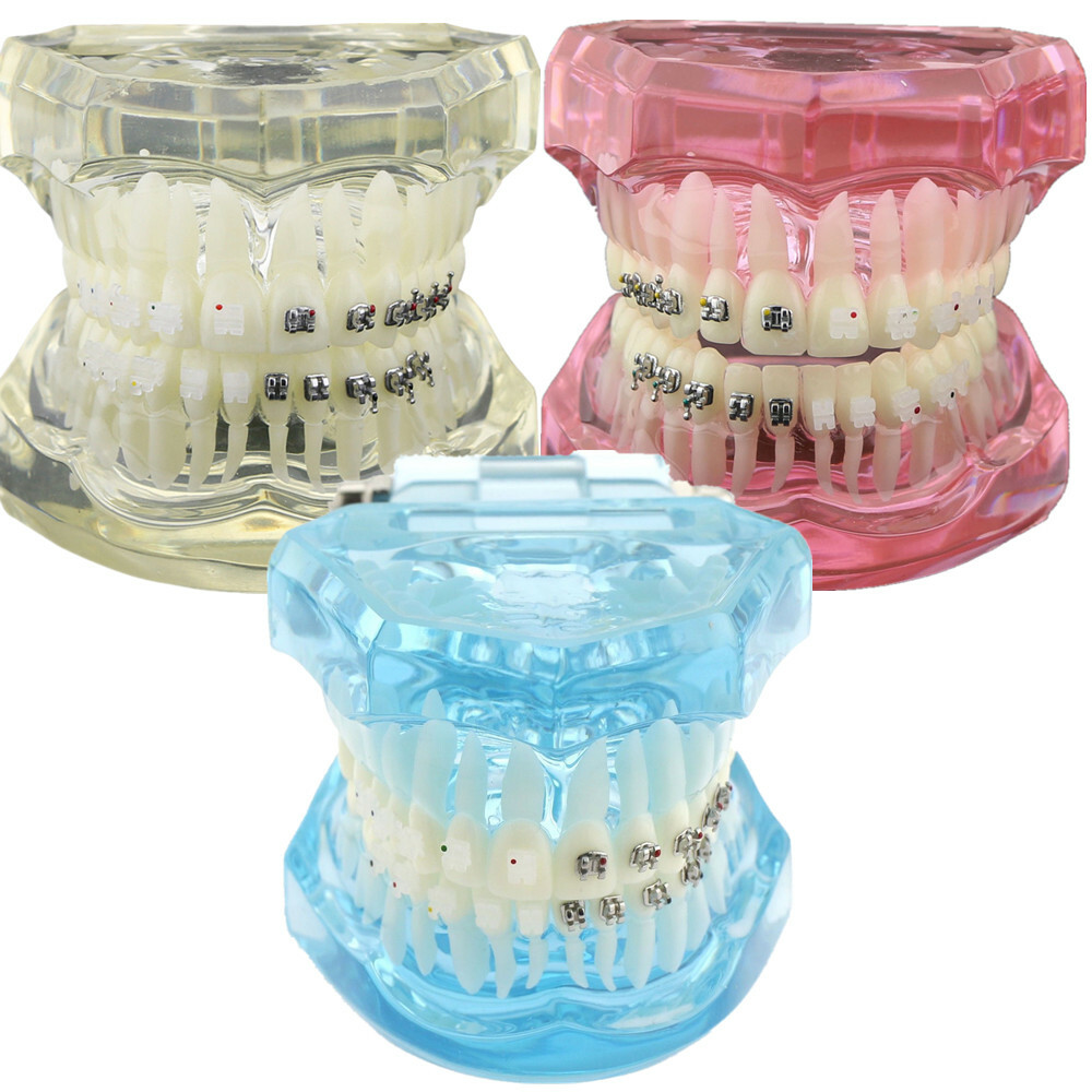 Dental Orthodontic Teeth Study Model with Metal Ceramic Bracket Braces 3003