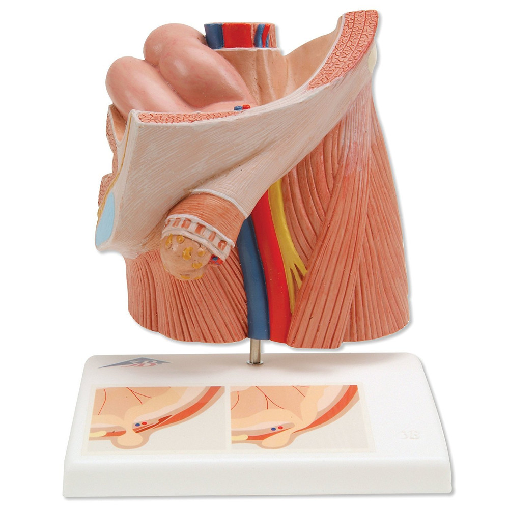 H13 Inguinal Hernia Model - 3B Smart Anatomy