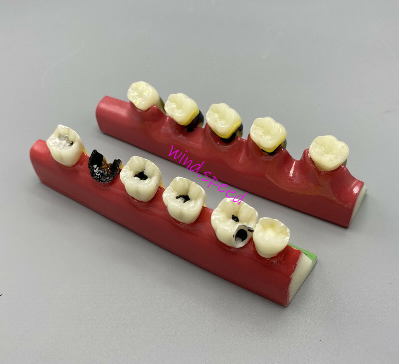 Dental Teeth Dentoform Models Caries Periodontal Disease Study Teaching Model