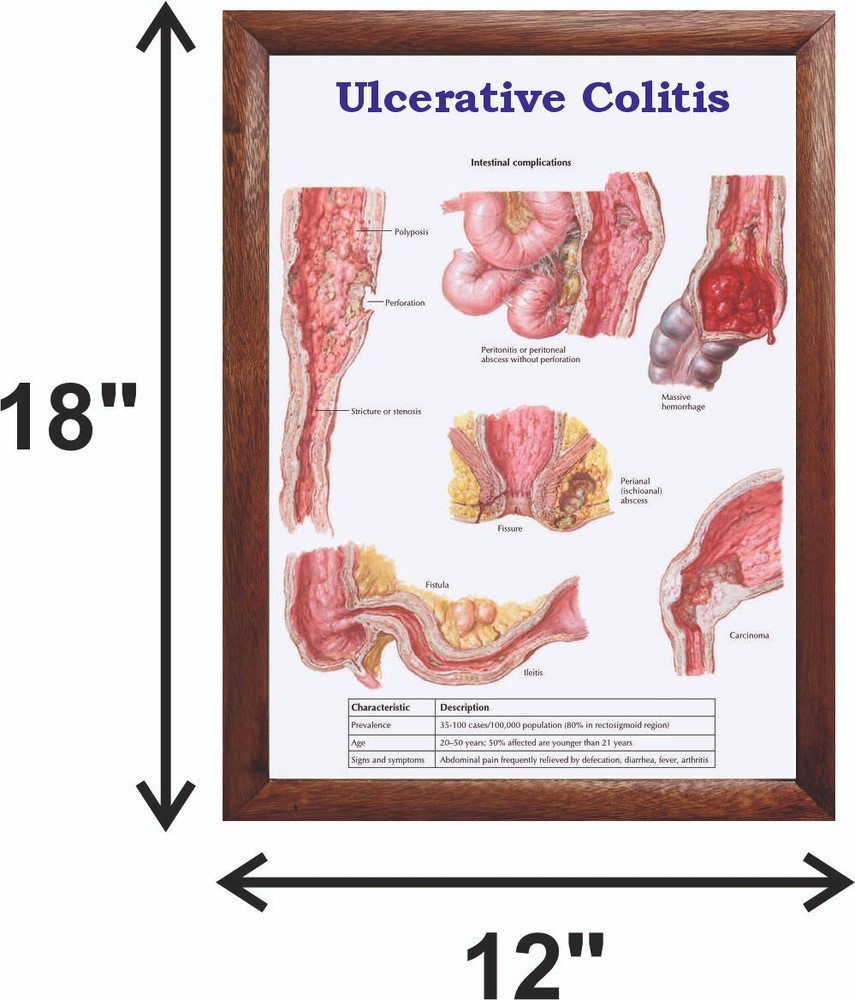 Ulcerative Colitis Chart 12x18 inches