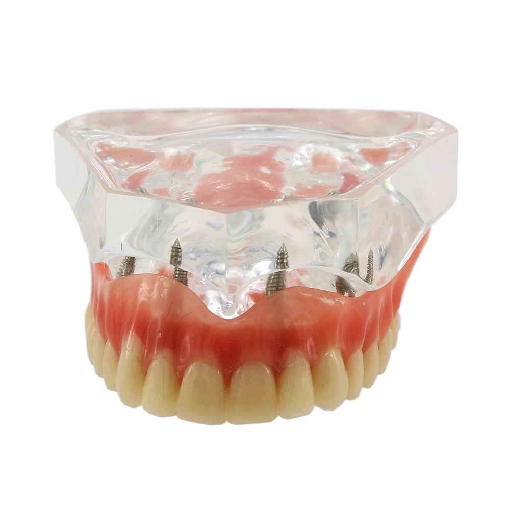 Dental Upper Implants Model Overdenture with 4 Superior Teeth Demo Transparen...