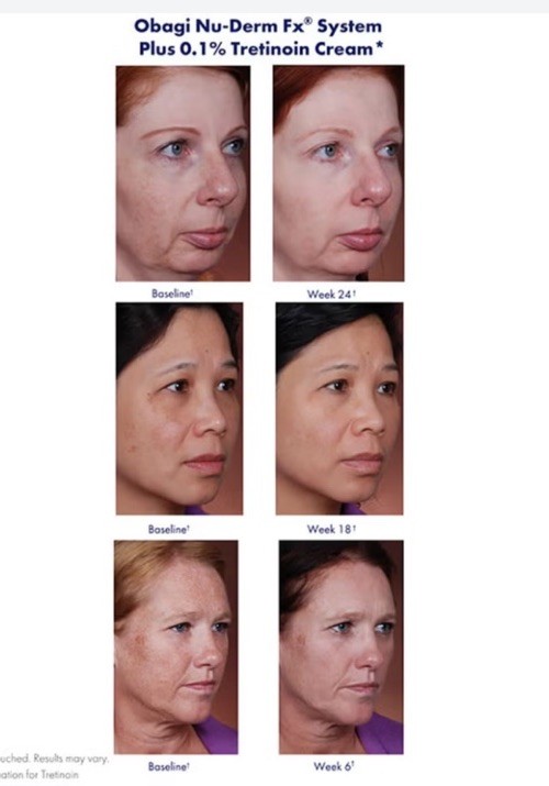 Obagi Nu Derm Toner 6.7oz 200ml AUTHENTIC Sealed