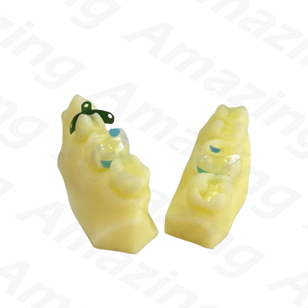 Dental Caries Decay Teeth Model Composite Resin Restore Tooth Simulate Class II