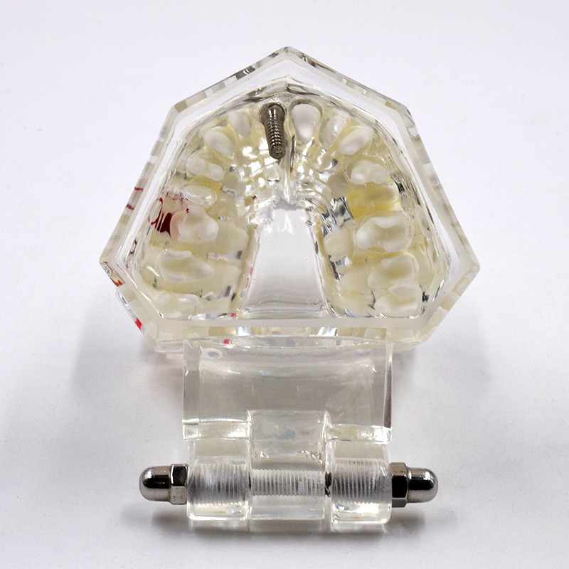 Dental Removable Restoration &Implant Pathological Disease Teeth Study Model