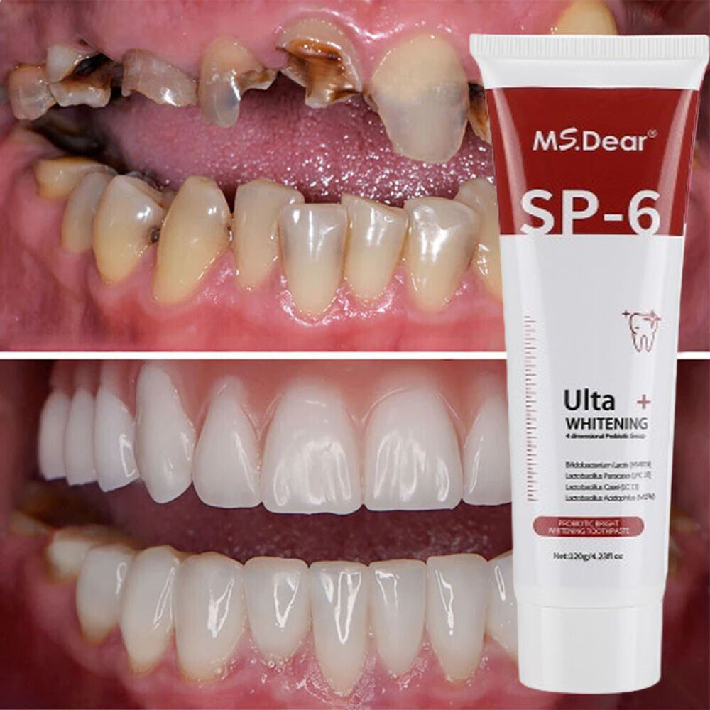 SP-6 Probiotic Toothpaste,Sp-6 Toothpaste Ultra Whitening Quick White Toothpaste