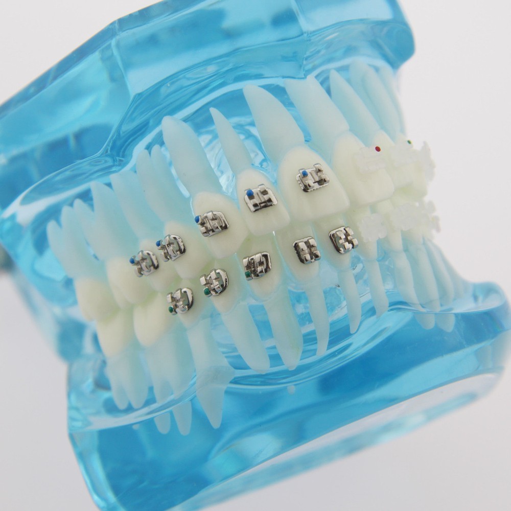 Dental Orthodontic Metal & Ceramic Bracket Brace Teeth Study Teach Model