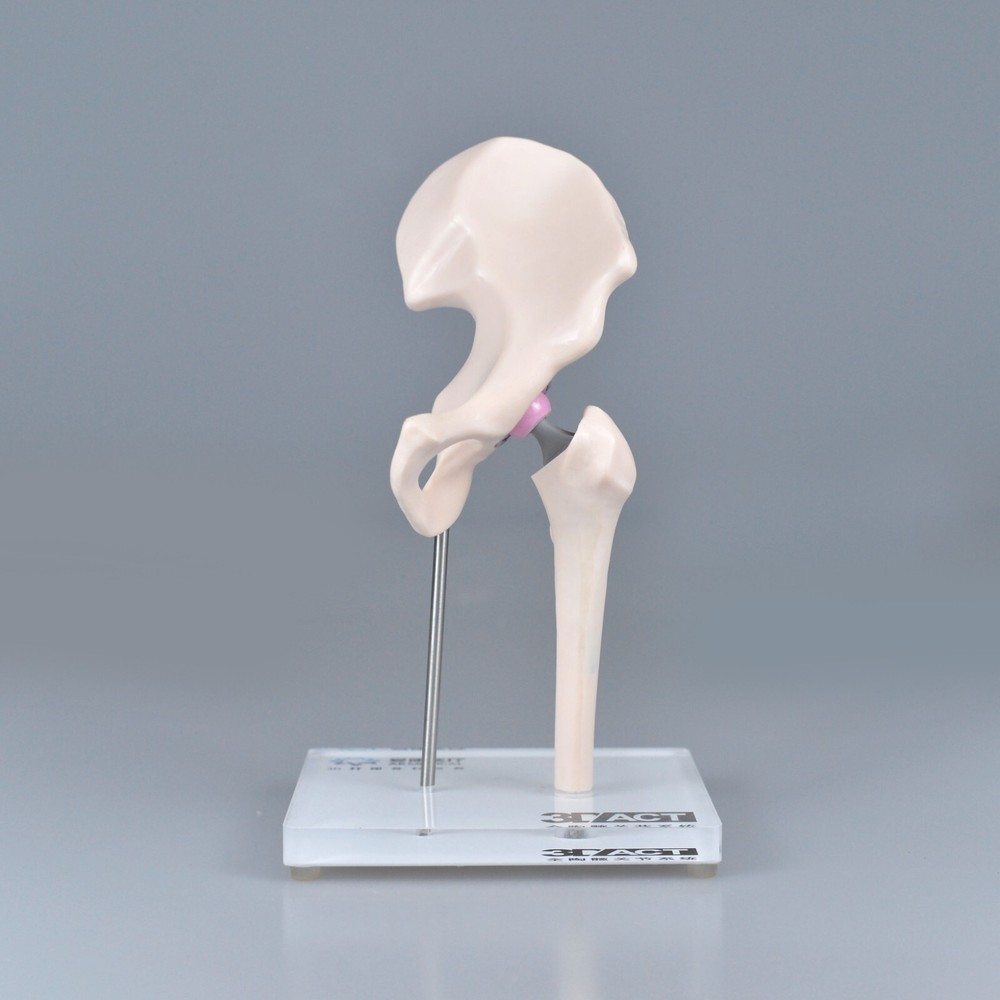 1/3 Artificial Hip Joint Replacement Anatomical Skeleton Demo Display Model