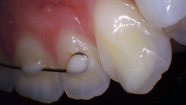 PerfectCam HD Intraoral Camera, USB Dental Camera, Free Capture Button Software.