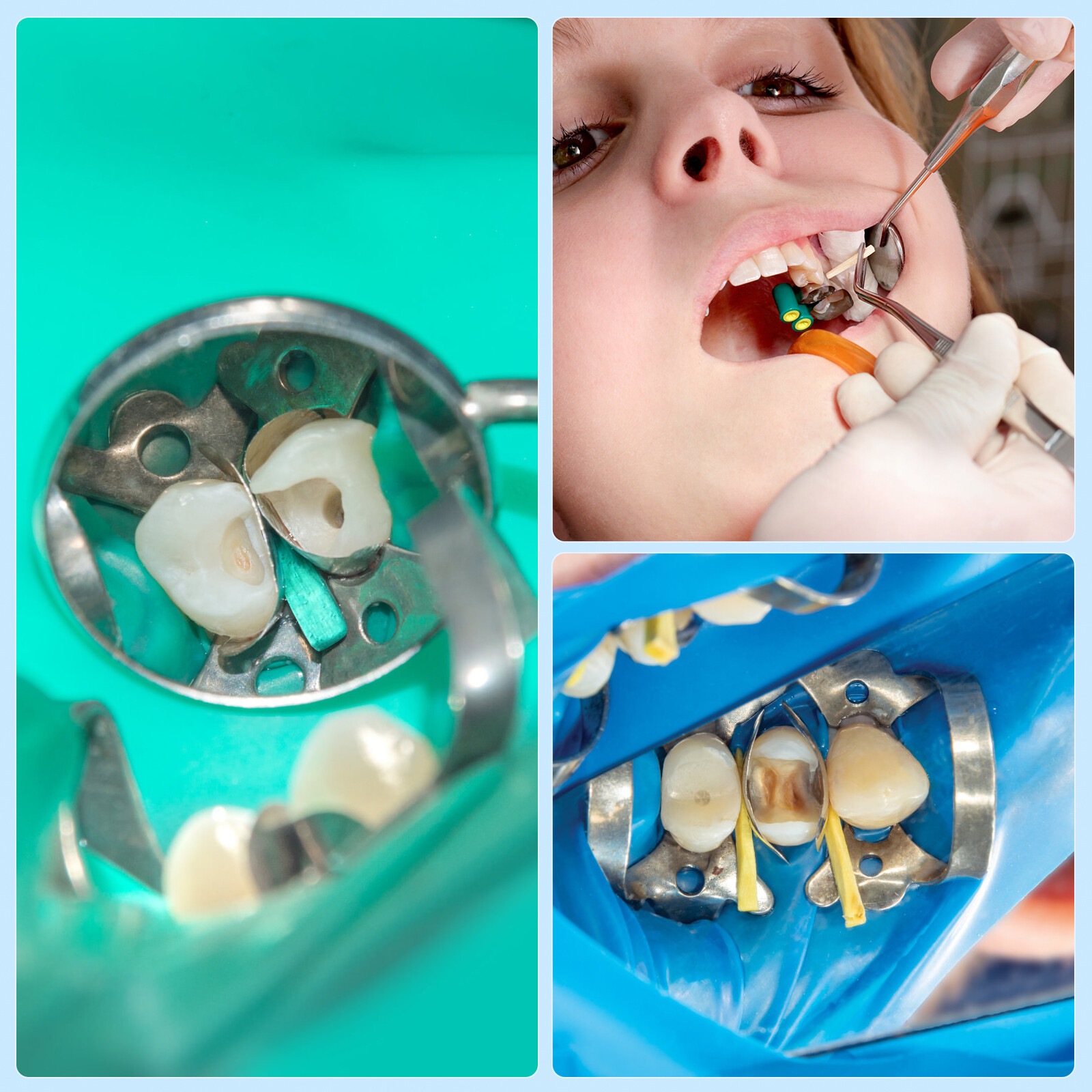 100/Box JMU Dental Wooden Interdental Wedges Contoured Matrices Wedges Tooth Gap