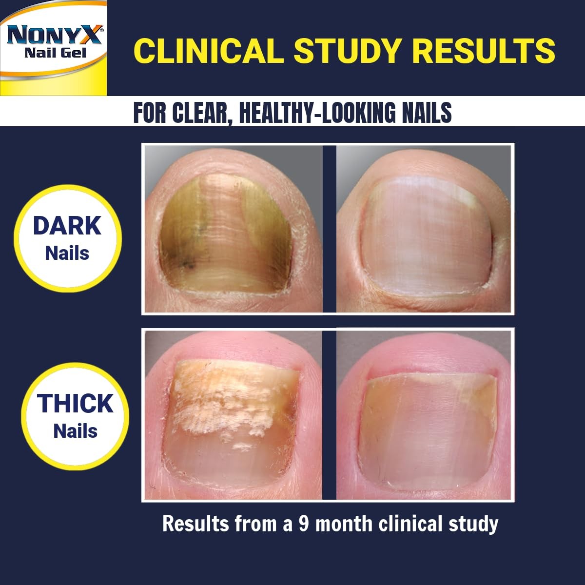 NONYX Fungal Nail Clarifying Gel - Discolored, Thick, Brittle Nails