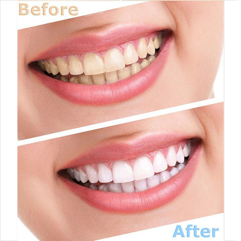 Handheld Teeth Whitening Machine Accelerator Bleaching Light 6000mw/c㎡ YS-TW-A