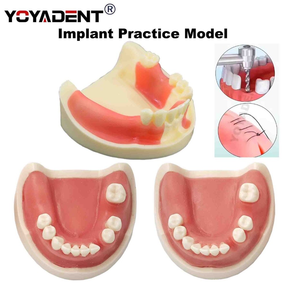 Dental Teeth Implant Practice Model For Dentistry Teaching Study Soft Gums