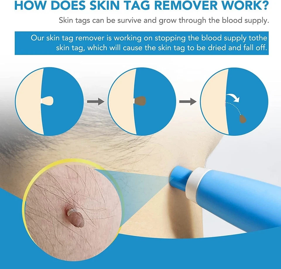 Auto Micro Skin Tag Remover Device Kit Safe Painless Removal 2-8 mm Band Tool