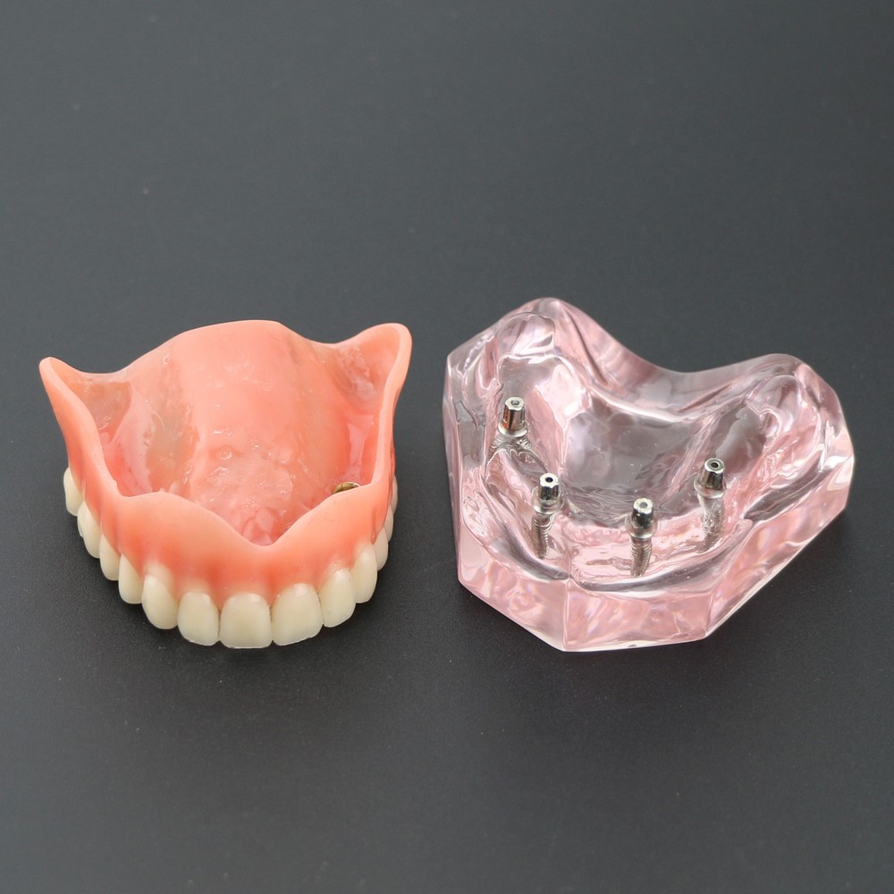 Dental Typodont Teeth Model Superior 4 Implants Overdenture Superior Demo Model