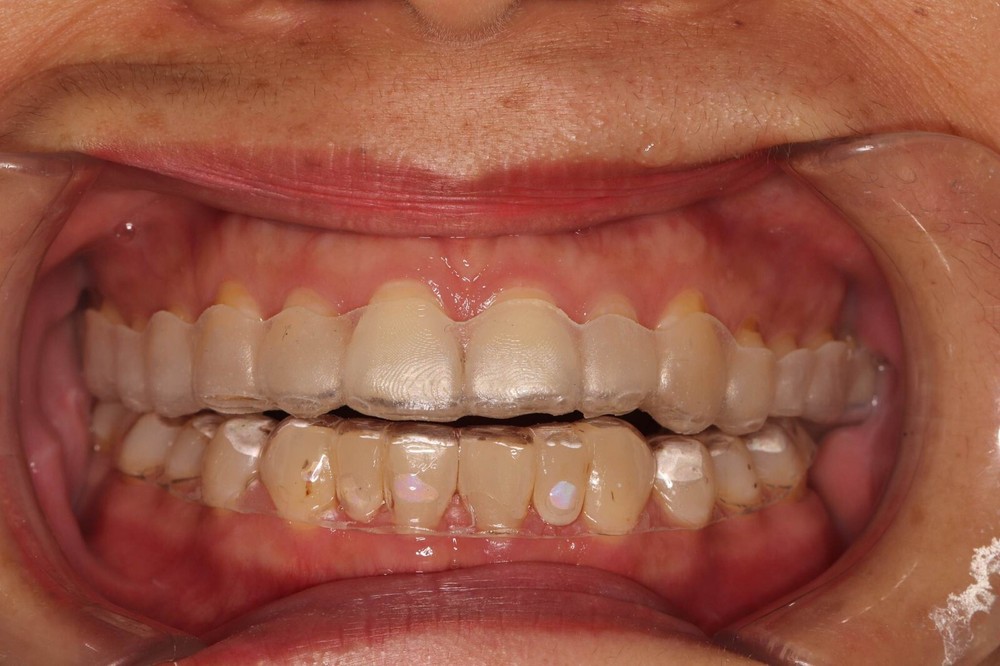 DLP SLA LCD 3d printer CLEAR ALIGNER resin