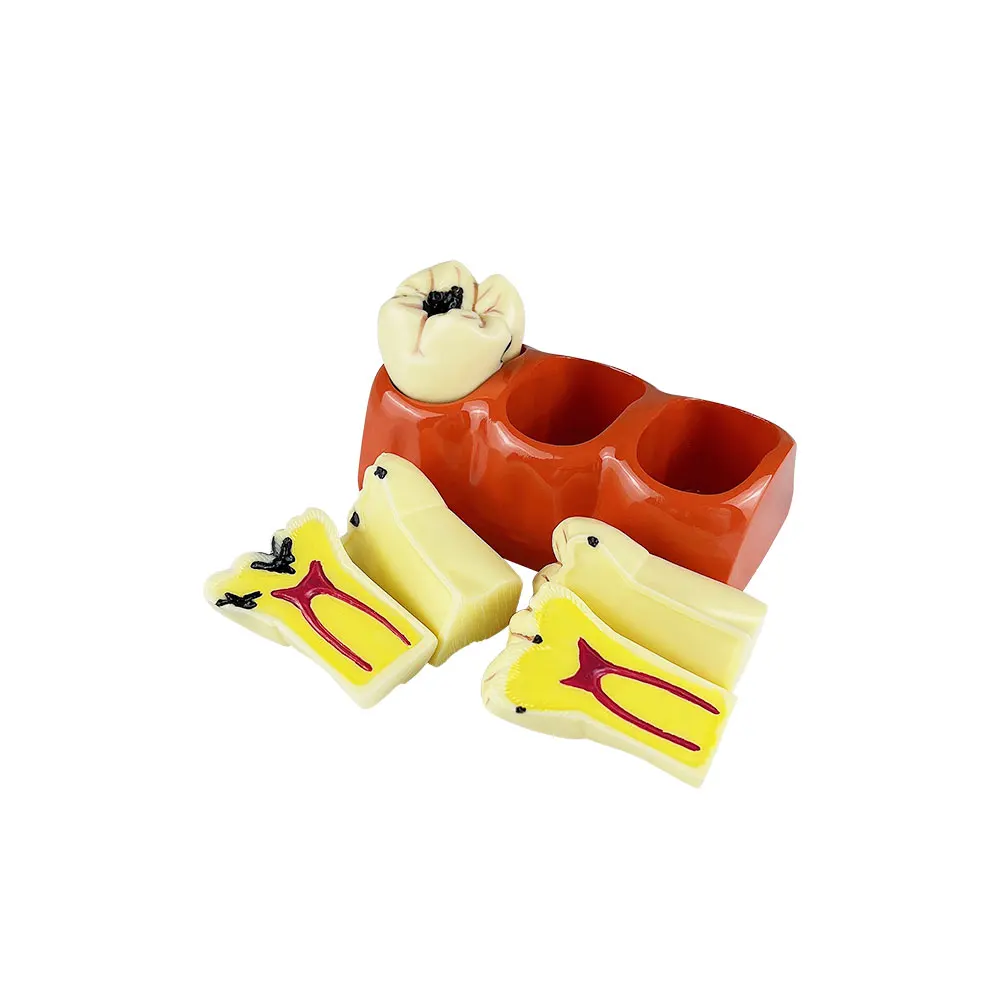 Dental 4 Times Caries Evolution Model Tooth Decay Comparsion Demonstration Model