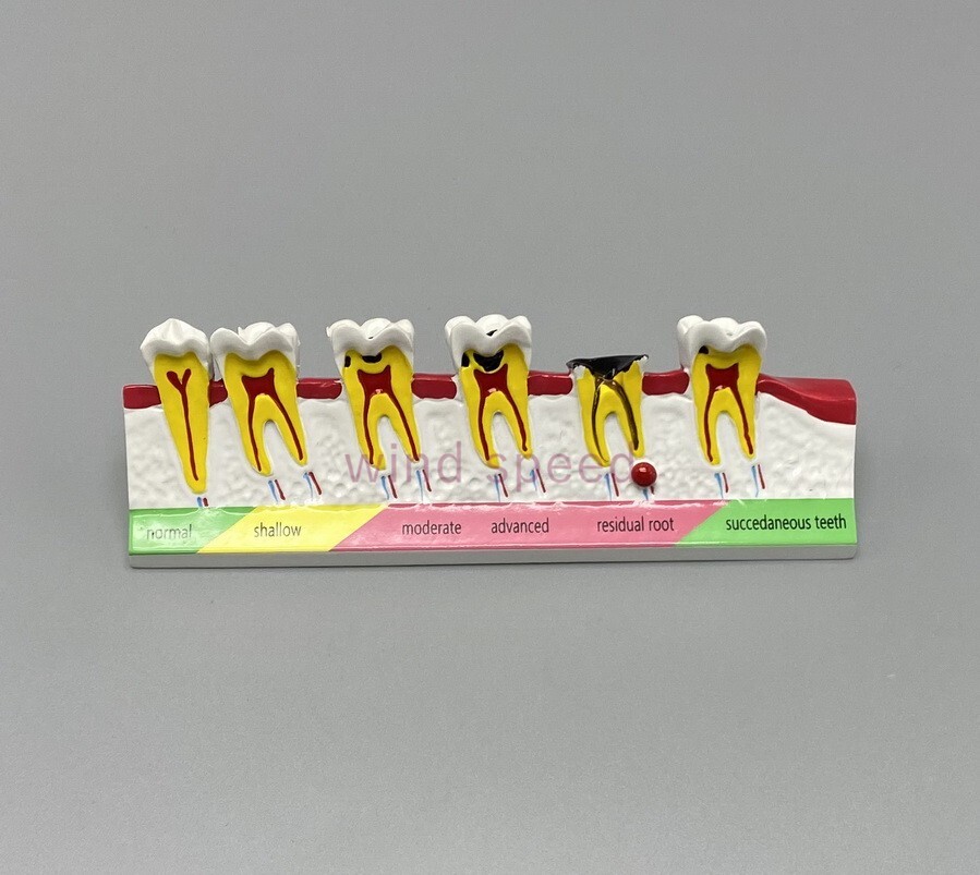 New Dental Study Teaching Models Caries Disease Assort Teeth Dentoform Model