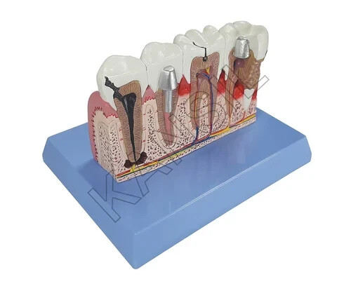 Teeth Pathologies Model ZX-1506P