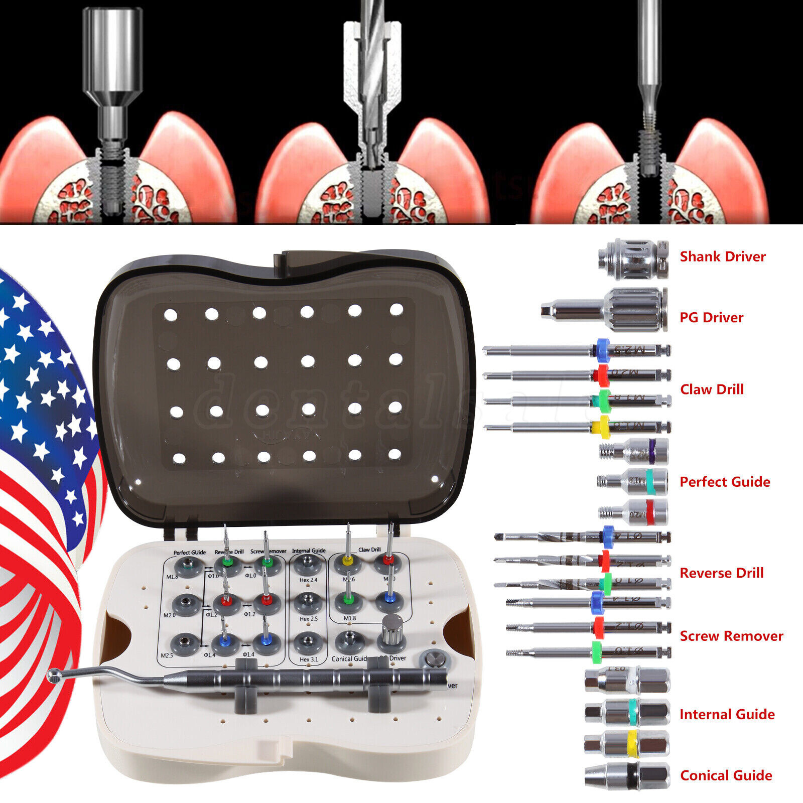 Dental Implant Fixture & Broken Screw Removal Kit Remove Surgical Tool Remover