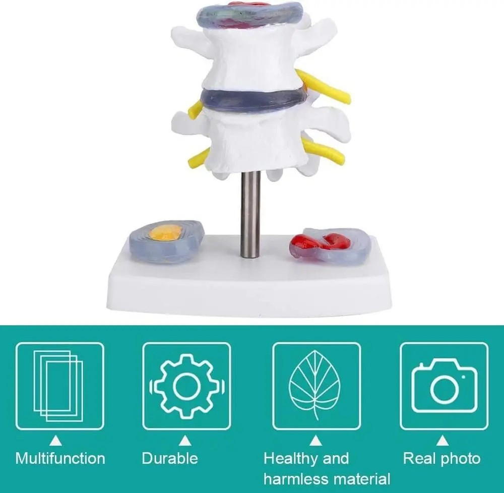 Anatomical Lumbar Disc Herniation Demonstration Model Human Spine