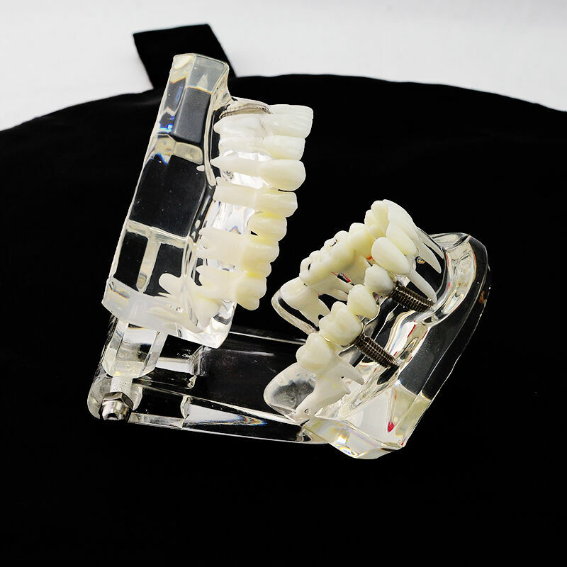 Dental Transparent Pathological Teeth Study Model Implant and Restoration Model